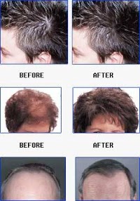 Hair Loss Treatment 320913 Image 1