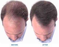 Hair Loss Treatment 320913 Image 2