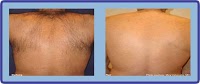 Laser Hair Removal Group 302492 Image 2