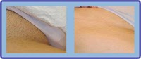 Laser Hair Removal Group 302492 Image 5