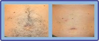 Laser Hair Removal Group 302492 Image 7