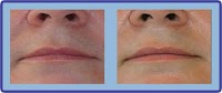 Laser Hair Removal Group 302492 Image 8