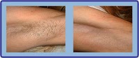 Laser Hair Removal Group 326732 Image 0
