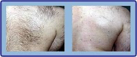 Laser Hair Removal Group 326732 Image 2