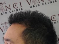 Vinci Hair Clinic 313012 Image 4